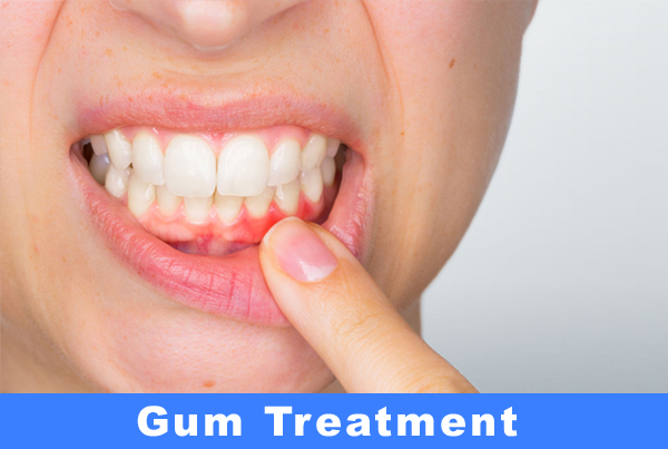 Gum Surgery